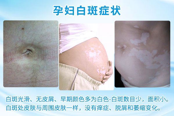预防护理-如何合理饮食预防白癜风呢